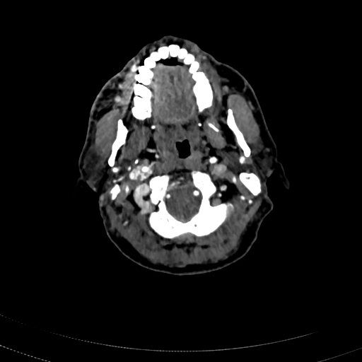 File:Carotid body tumor (Radiopaedia 83615-98727 A 33).jpg