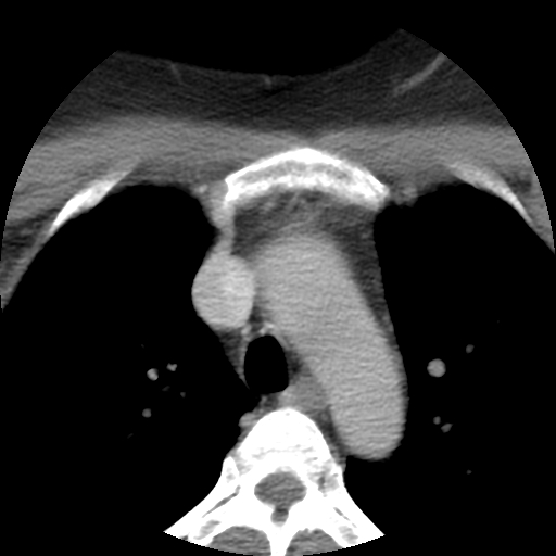 File:Carotid body tumor (paraganglioma) (Radiopaedia 38586-40729 A 36).jpg