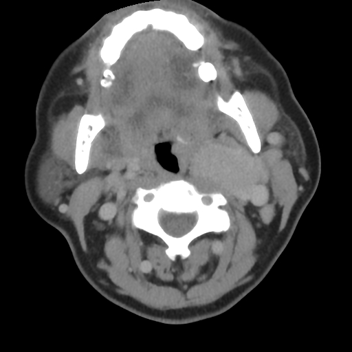 Carotid body tumor (paraganglioma) (Radiopaedia 38586-40729 A 50).jpg
