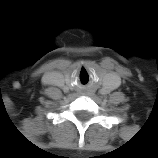 Carotid body tumor (paraganglioma) (Radiopaedia 38586-40729 A 61).jpg