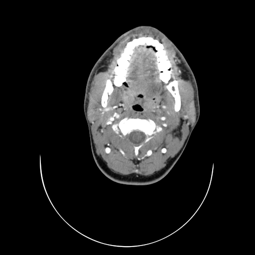 File:Carotid bulb pseudoaneurysm (Radiopaedia 57670-64616 A 17).jpg