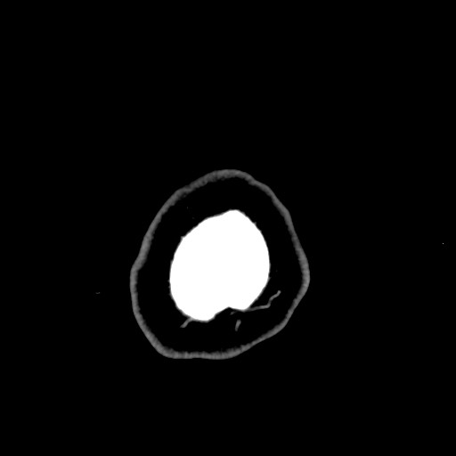 Carotid canal sympathetic schwannoma (Radiopaedia 68925-78671 Axial venous 57).jpg