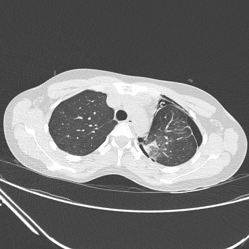 File:Catamenial pneumothorax (Radiopaedia 27946-28197 lung window 50).jpg