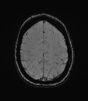 File:Cavernoma with bleed - midbrain (Radiopaedia 54546-60773 Axial SWI 38).png