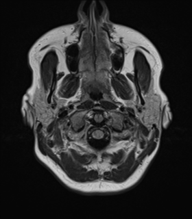 File:Cavernoma with bleed - midbrain (Radiopaedia 54546-60774 Axial FLAIR 2).png