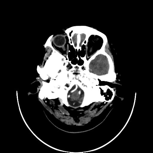 File:Cavernoma with developmental venous anomaly (Radiopaedia 22470-22506 C+ arterial phase 3).jpg