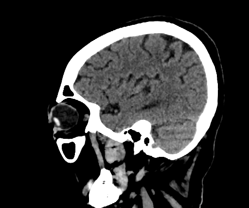 Cavernous hemangioma of the cerebellar falx (Radiopaedia 73025-83723 B 247).jpg