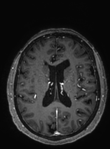 File:Cavernous hemangioma of the cerebellar falx (Radiopaedia 73025-83724 Axial T1 C+ 137).jpg