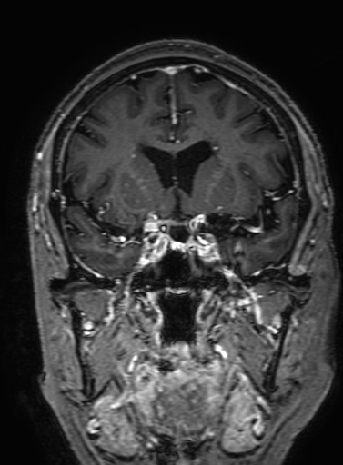Cavernous hemangioma of the cerebellar falx (Radiopaedia 73025-83724 Coronal T1 C+ 146).jpg