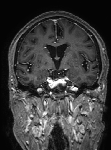Cavernous hemangioma of the cerebellar falx (Radiopaedia 73025-83724 Coronal T1 C+ 173).jpg