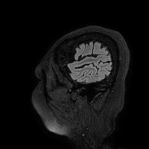 Cavernous hemangioma of the cerebellar falx (Radiopaedia 73025-83724 Sagittal FLAIR 10).jpg