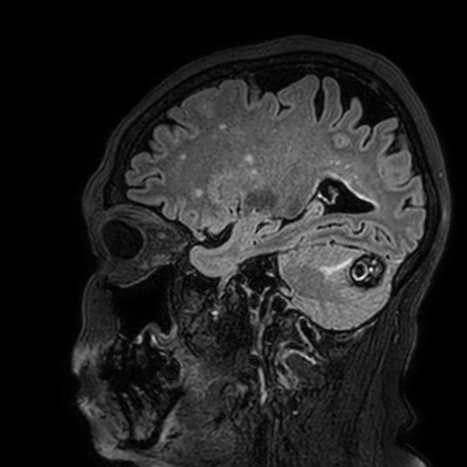 Cavernous hemangioma of the cerebellar falx (Radiopaedia 73025-83724 Sagittal FLAIR 151).jpg