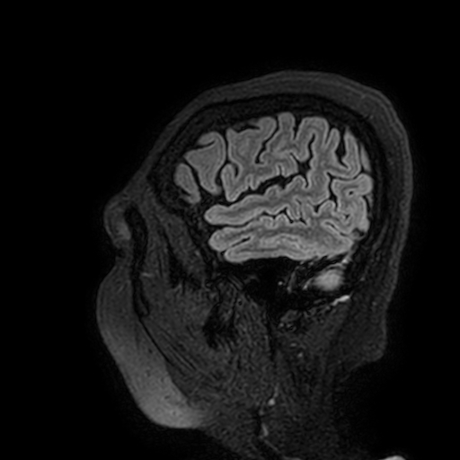 File:Cavernous hemangioma of the cerebellar falx (Radiopaedia 73025-83724 Sagittal FLAIR 194).jpg