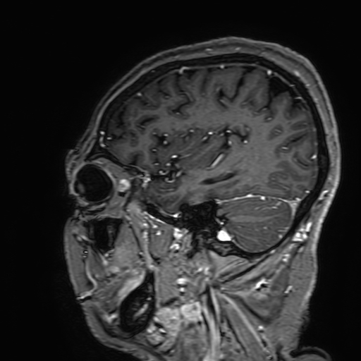 Cavernous hemangioma of the cerebellar falx (Radiopaedia 73025-83724 Sagittal T1 C+ 160).jpg