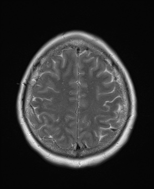 File:Cavernous sinus meningioma (Radiopaedia 63682-72367 Axial T2 18).jpg
