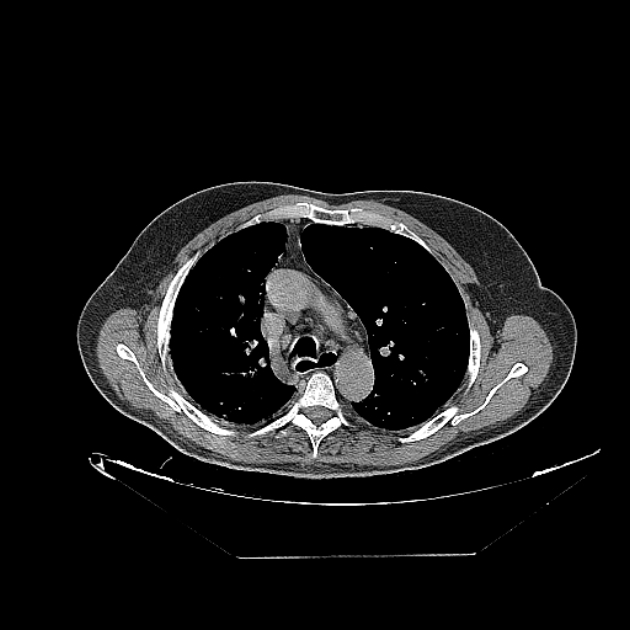 Cavitating bronchogenic carcinoma (Radiopaedia 44489-48162 Axial non-contrast 29).jpg