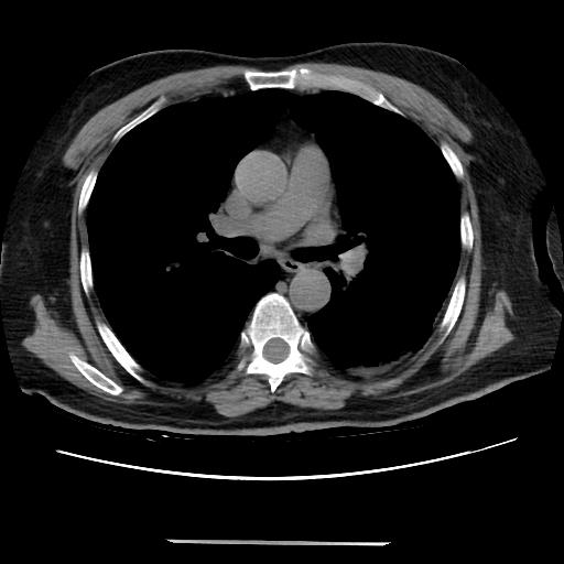 Cavitating pulmonary metastases (Radiopaedia 89545-106544 Axial non-contrast 26).jpg