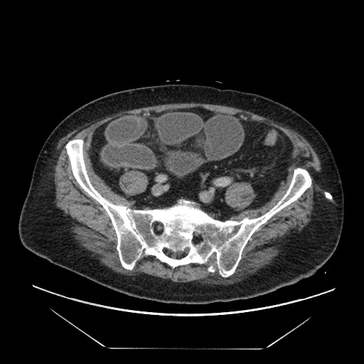 Cecal adenocarcinoma (Radiopaedia 64871-73817 A 71).jpg
