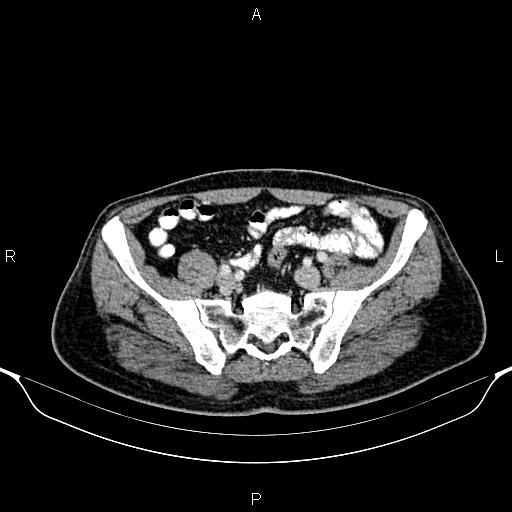 File:Cecal adenocarcinoma (Radiopaedia 85324-100916 B 74).jpg