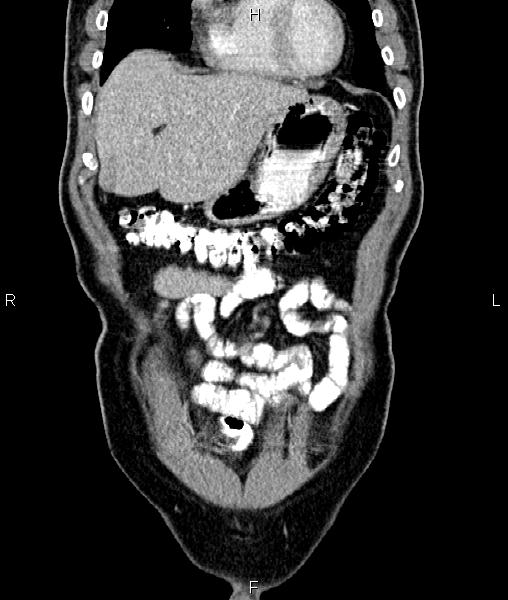 File:Cecal cancer with appendiceal mucocele (Radiopaedia 91080-108651 D 14).jpg