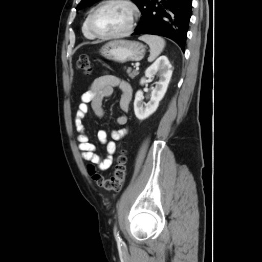 Cecal mass causing appendicitis (Radiopaedia 59207-66531 C 47).jpg