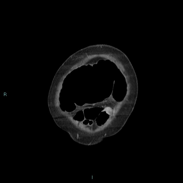 Cecal volvulus (Radiopaedia 71372-81698 C 11).jpg