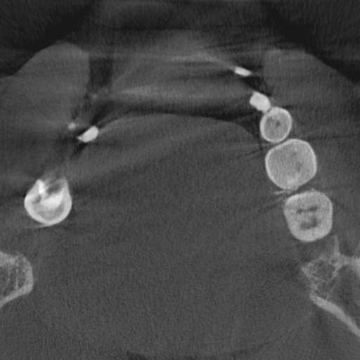 Cemento-osseous dysplasia (Radiopaedia 48251-53126 Axial non-contrast 65).jpg