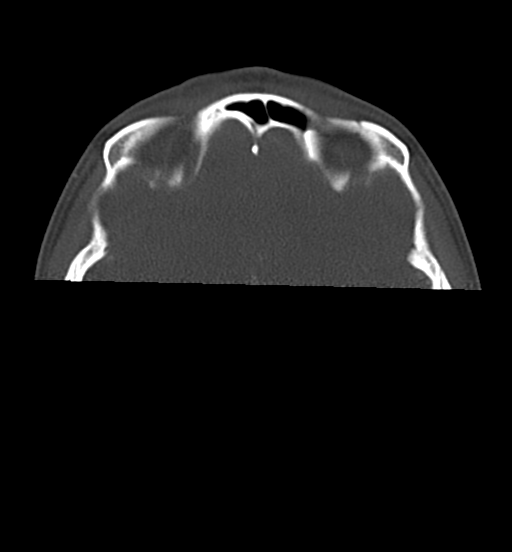 Cemento-ossifying fibroma (Radiopaedia 46243-50643 Axial bone window 12).png