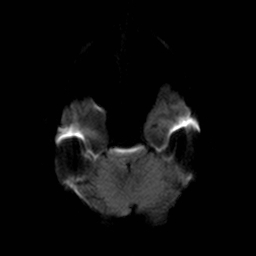 File:Central-variant posterior reversible encephalopathy syndrome (PRES) (Radiopaedia 43880-47358 Axial DWI 6).jpg