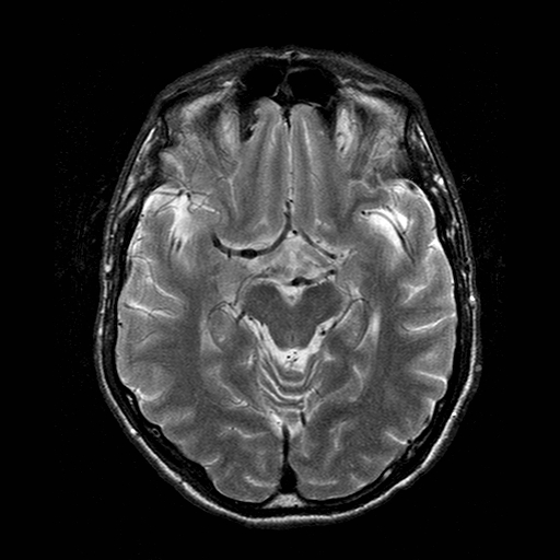 File:Central-variant posterior reversible encephalopathy syndrome (PRES) (Radiopaedia 43880-47359 Axial T2 9).jpg