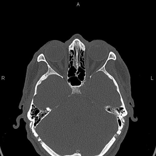File:Central giant cell granuloma (Radiopaedia 83346-97761 Axial bone window 58).jpg