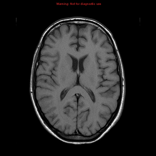 File:Central nervous system vasculitis (Radiopaedia 8410-9235 Axial T1 14).jpg