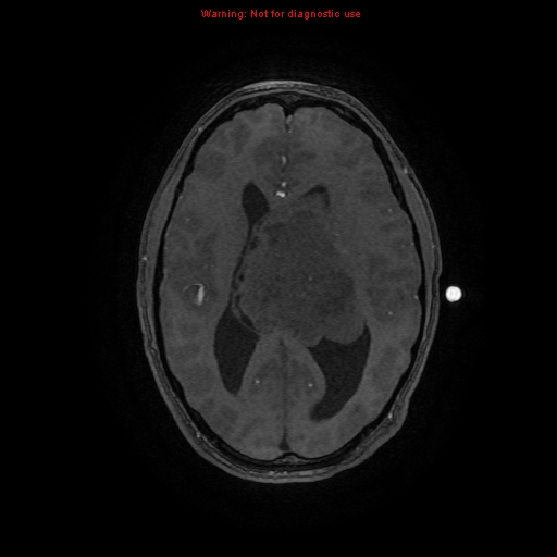 Central neurocytoma (Radiopaedia 13188-13206 Axial MRA 22).jpg