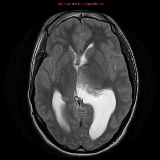File:Central neurocytoma (Radiopaedia 13188-13206 Axial T2 1).jpg