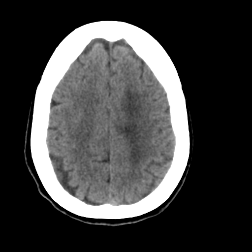 File:Central neurocytoma (Radiopaedia 65317-74346 Axial non-contrast 38).png
