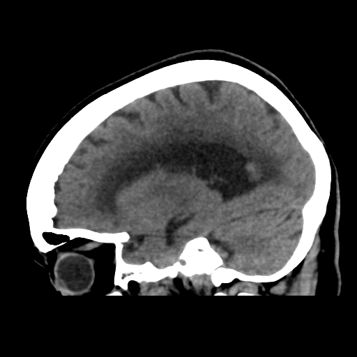 File:Central neurocytoma (Radiopaedia 65317-74346 C 19).png