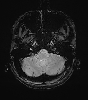 File:Central neurocytoma (Radiopaedia 71068-81303 Axial SWI 5).jpg