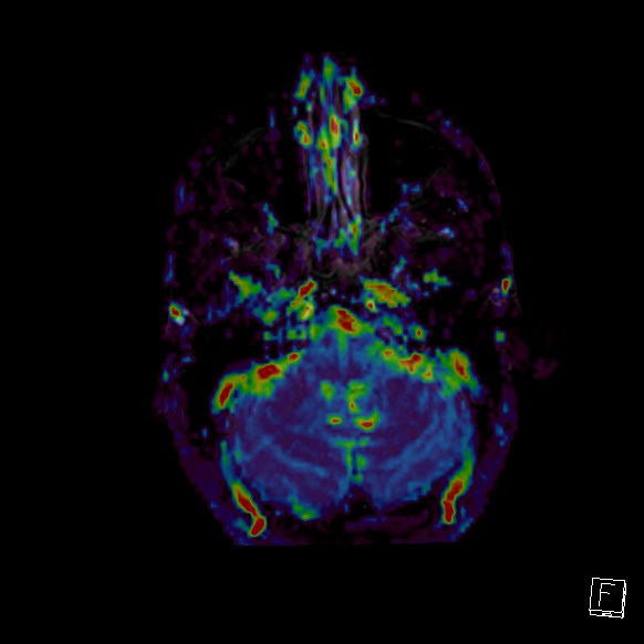 Central neurocytoma (Radiopaedia 84497-99872 Axial Perfusion 265).jpg