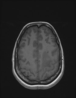 Central neurocytoma (Radiopaedia 84497-99872 Axial T1 151).jpg