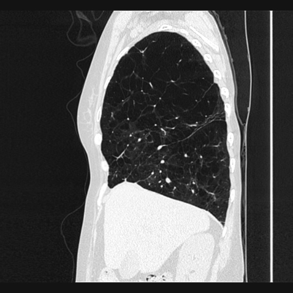 Centrilobular pulmonary emphysema (Radiopaedia 24495-24789 Sagittal lung window 21).jpg