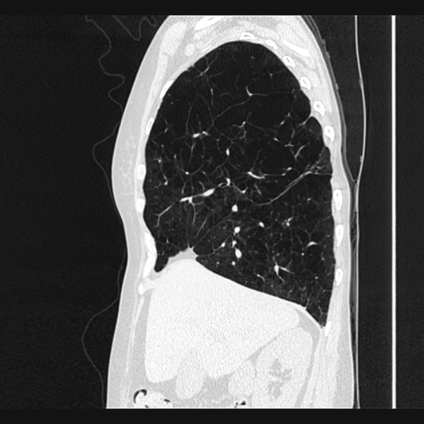 Centrilobular pulmonary emphysema (Radiopaedia 24495-24789 Sagittal lung window 24).jpg