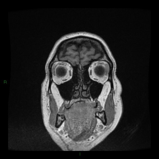 Cerebellar abscess (Radiopaedia 78135-90678 Coronal T1 C+ 20).jpg