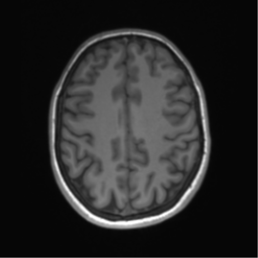 Cerebellar agenesis with hypoplastic pons (pontocerebellar hypoplasia) (Radiopaedia 57224-64138 Axial T1 55).png