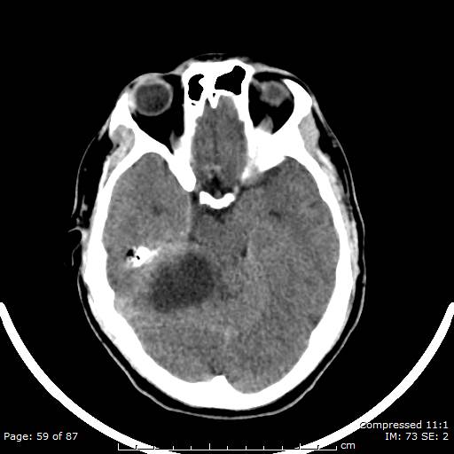 Cerebellar hemangioblastoma (Radiopaedia 52360-58258 Axial non-contrast 59).jpg
