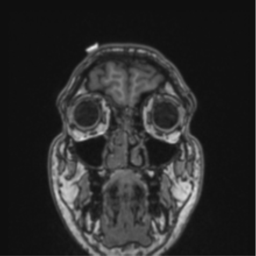 Cerebellar hemangioblastomas and pituitary adenoma (Radiopaedia 85490-101176 Coronal T1 80).png