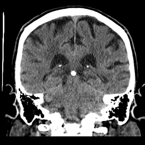 Cerebellar hemorrhage (Radiopaedia 27193-27359 Coronal non-contrast 37).jpg