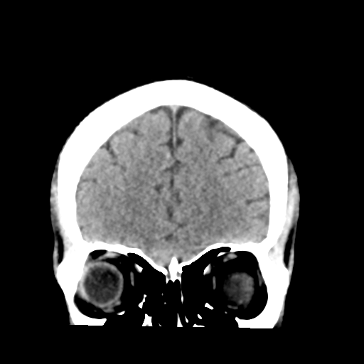 File:Cerebellar hemorrhage (Radiopaedia 37000-38669 Coronal non-contrast 10).png