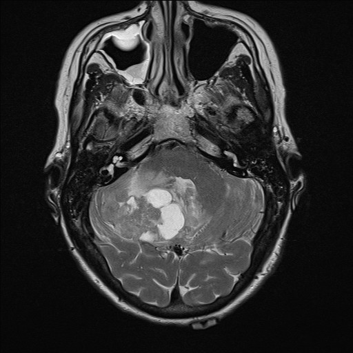 File:Cerebellar metastases (Radiopaedia 24038-24249 Axial T2 10).jpg