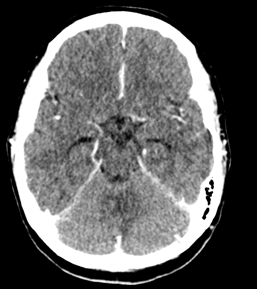 Cerebellar metastases - colorectal adenocarcinoma (Radiopaedia 40947-43652 Axial C+ 20).png