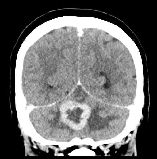 Cerebellar metastasis (Radiopaedia 54578-60812 Coronal C+ 46).png